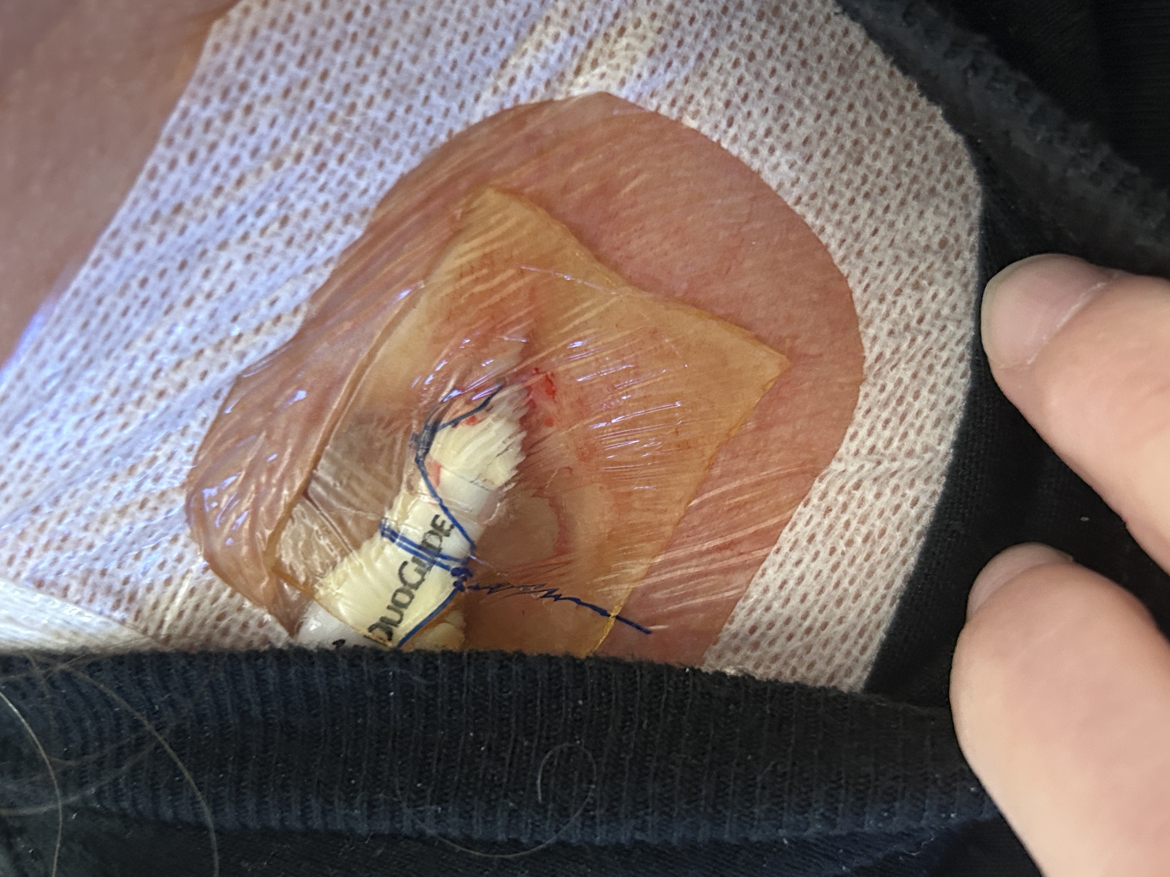 Temporary catheter site used during Karla's apheresis process